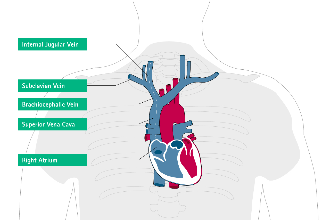 Misplacement and Malposition of Central Venous Catheters